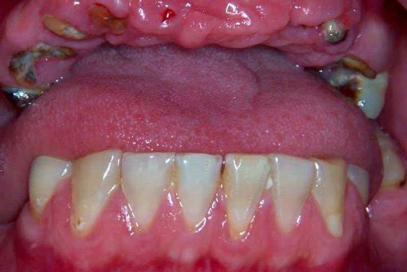 Before full mouth implant