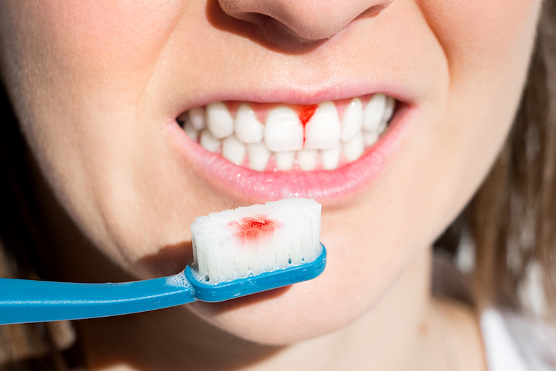 Don’t Ignore Bleeding Gums in Burke, VA: What It Could Mean for Your Oral Health