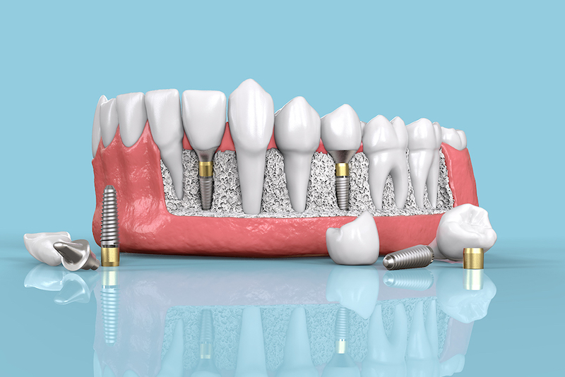 More Than Just a Smile: The Impact of Dental Implants on Your Overall Health in Burke, VA