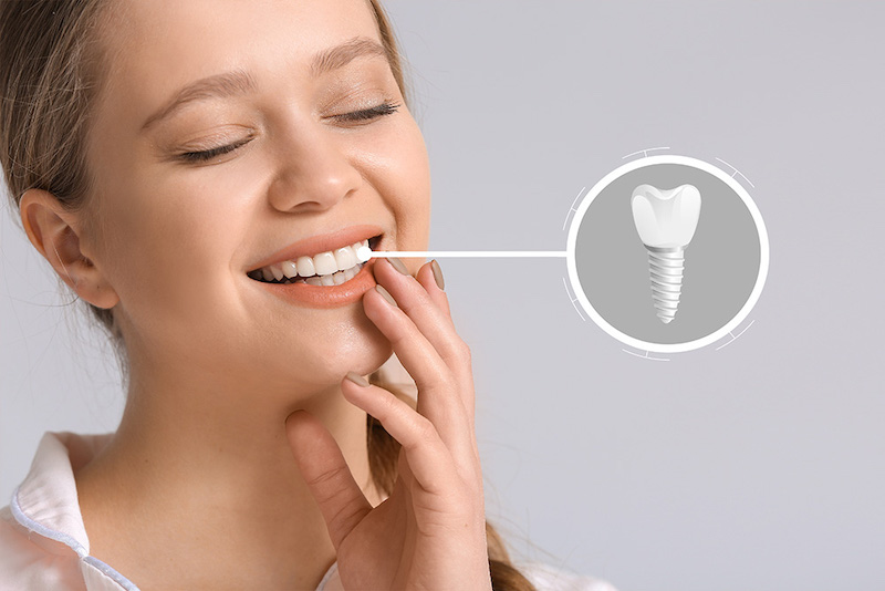 Unraveling Dental Implants: Your Ultimate Guide to a Confident Smile in Burke, VA