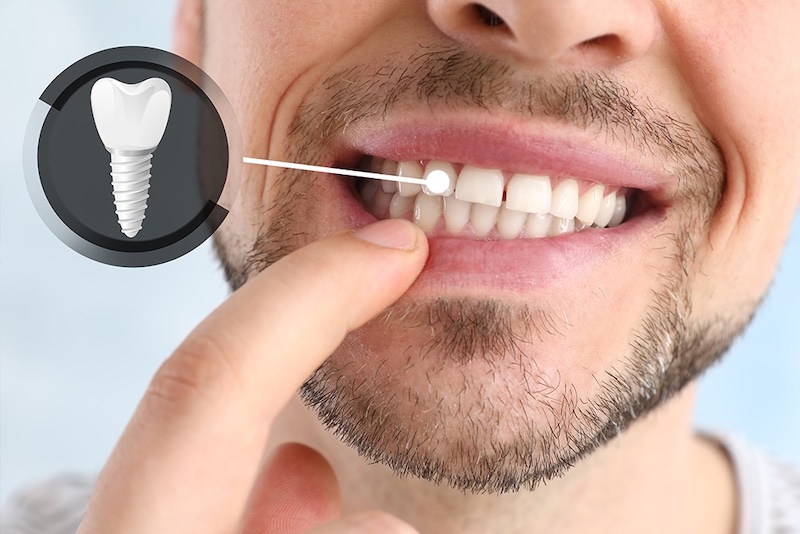 Tooth Replacement Options in Burke, VA: Which One Is Right For You?
