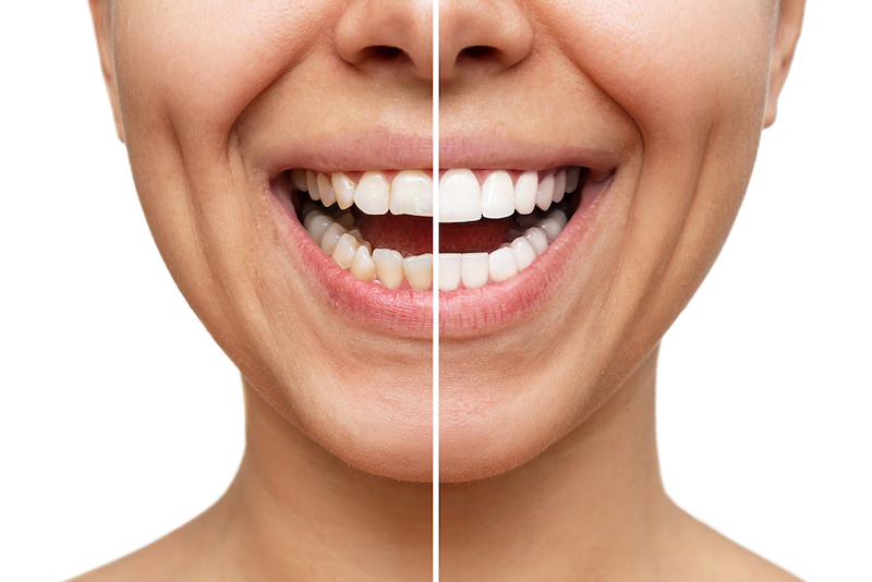 Transform Your Smile with Veneers in Burke, VA: A Comprehensive Guide
