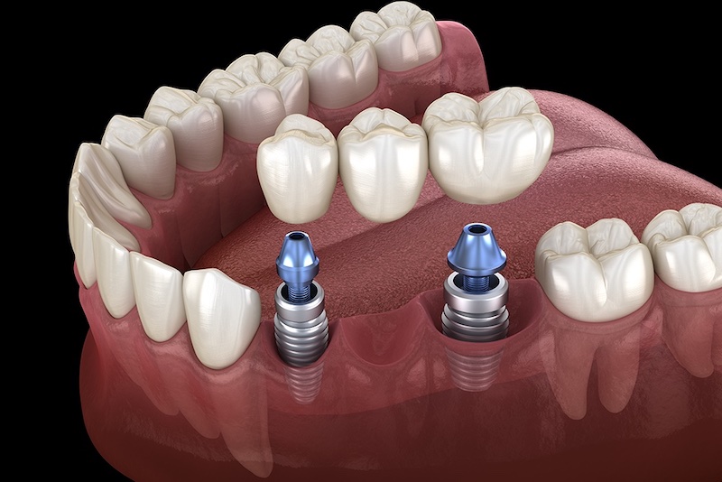 The Dental Implant Bridge in Burke, VA: Everything You Need to Know