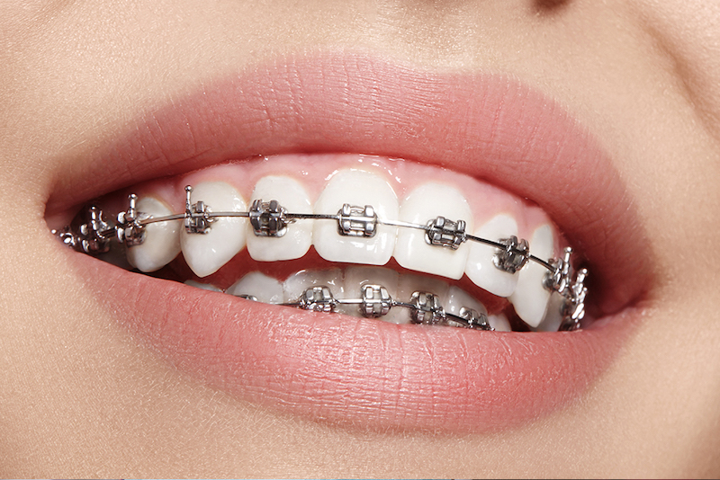 How Metal Braces Work to Correct Teeth Misalignment in Burke, VA