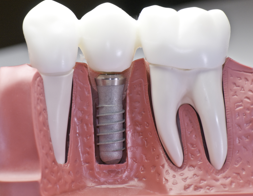Dental Implants – Associated Costs in Burke, VA