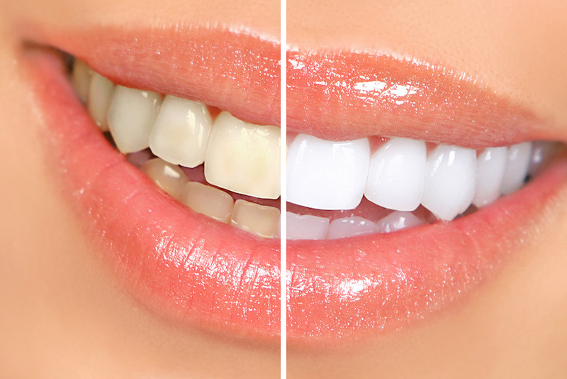 Brighten Your Grin: Exploring Professional Teeth Whitening Methods in Burke, VA