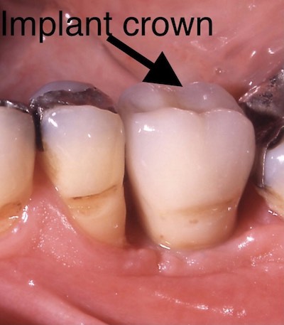 Implant Crown