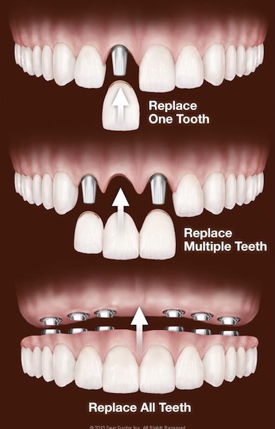 Implant types